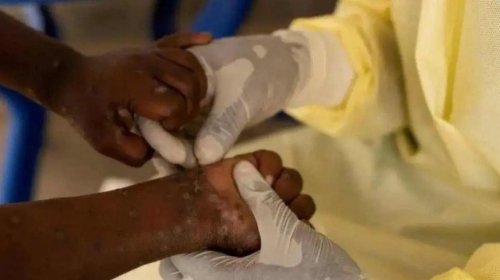 [Sesab reclassifica caso suspeito de Mpox na Bahia e confirma apenas um paciente no estado]