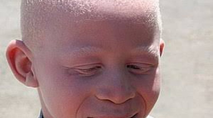 [Pessoas com acromatismo (albinismo) passam a ter prioridades em especialidades no SUS]