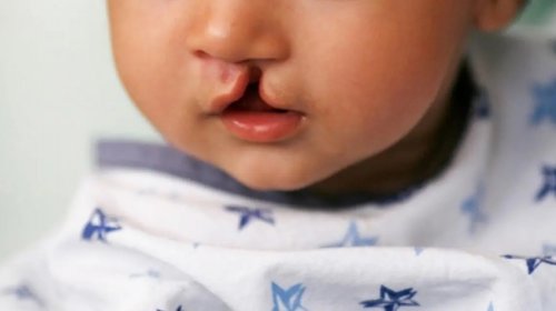 [Cirurgias para correção de lábio leporino aumentam mais de 40% em Salvador nos últimos três anos]