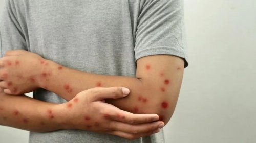 [OMS mantém mpox como emergência global de saúde pública]