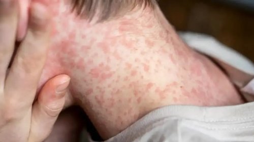 [Avanço do sarampo leva Nova York a decretar emergência sanitária]