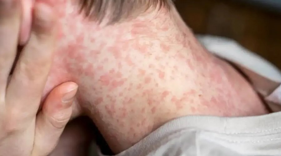[Avanço do sarampo leva Nova York a decretar emergência sanitária]