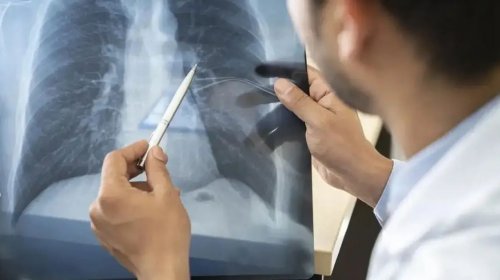 [Anvisa autoriza medicamento para pacientes com tipo específico de câncer de pulmão avançado]