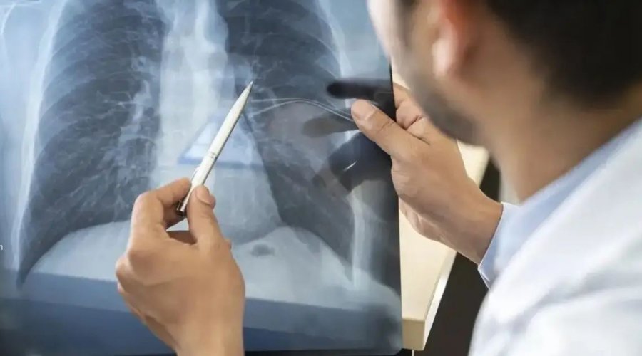[Anvisa autoriza medicamento para pacientes com tipo específico de câncer de pulmão avançado]